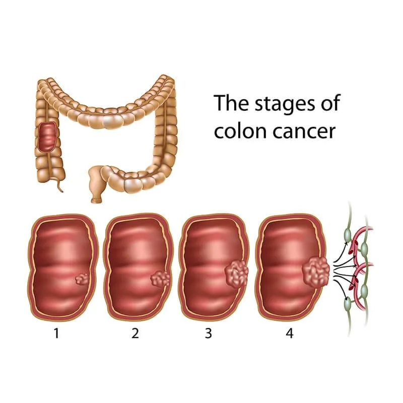 Stages of Colon Cancer - Colon Cancer Treatment in India | Cytecare