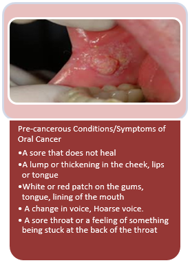 Oral cancer symptoms