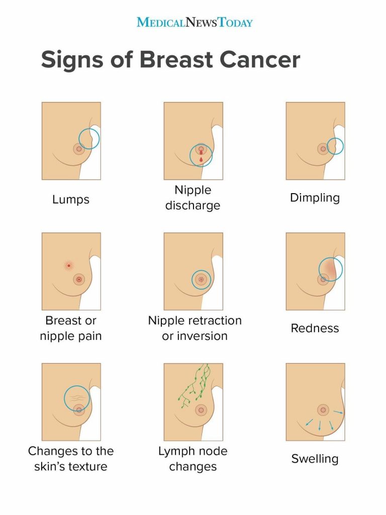 breast cancer signs and symptoms