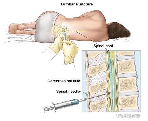 lumbar puncture for diagnosis of blood cancer