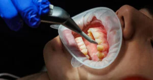 Dental Fluorosis